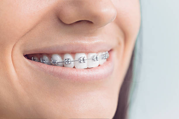 Dental Bonding in Chico, TX